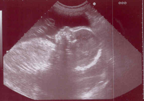 Imagen en blanco y negro de una ecografía donde se ve la cabeza y el torso del bebé.